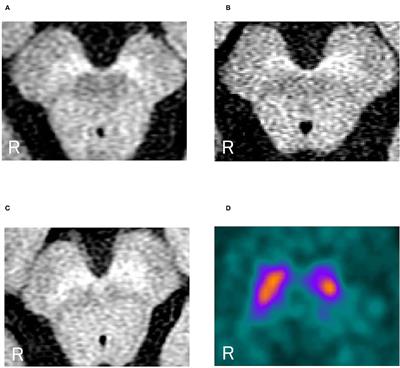 Is Generalized and Segmental Dystonia Accompanied by Impairments in the Dopaminergic System?